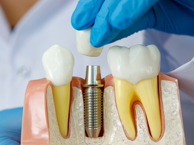 Clínica de Implantes Dentários Maringa PR