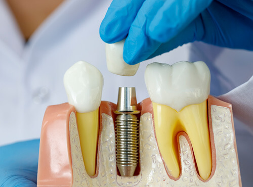 Clínica de Implantes Dentários - Maringa - PR